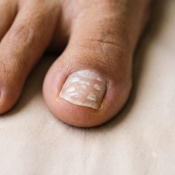 Unhas Esbranquiçadas