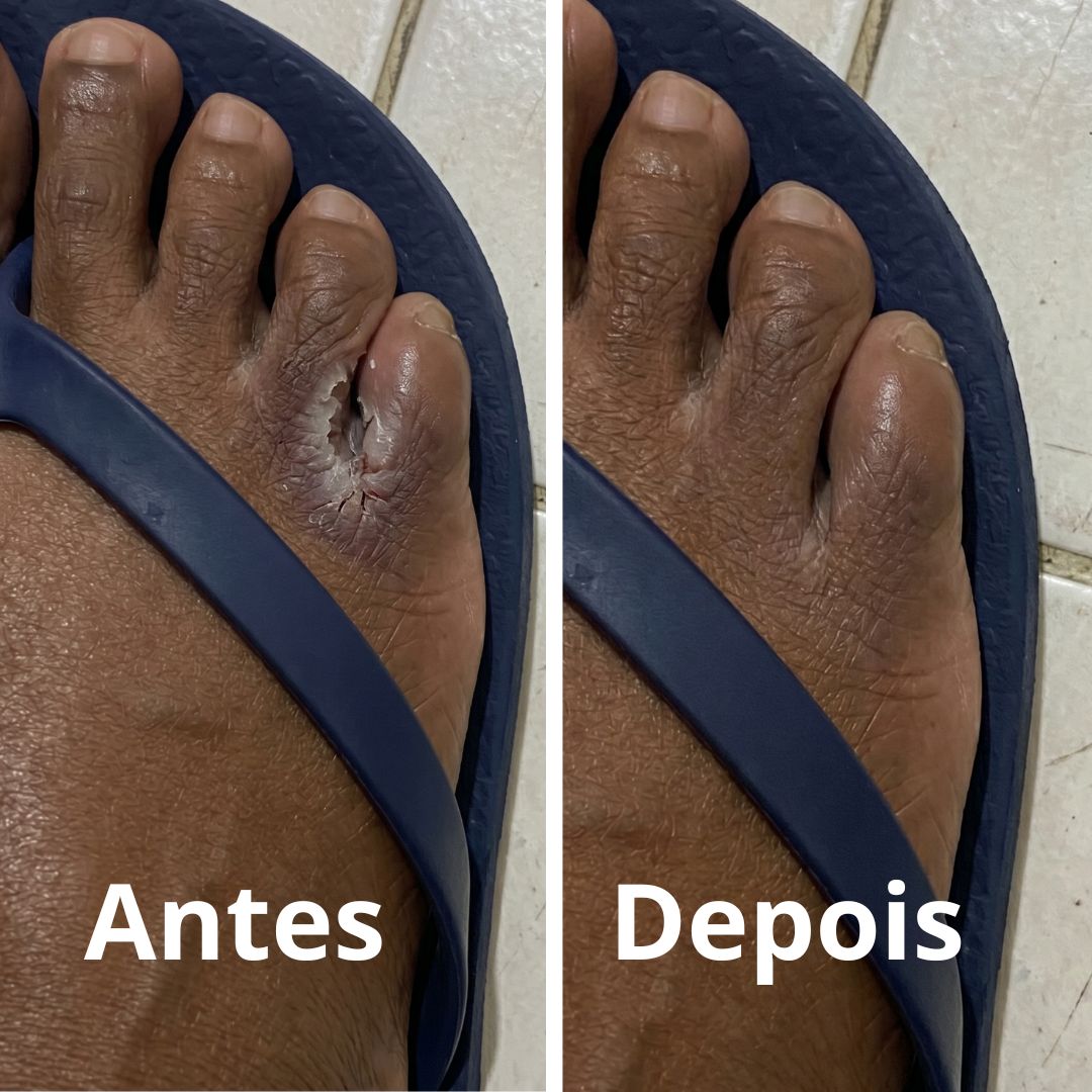 Antes e depois do tratamento com Blend Fungicida
