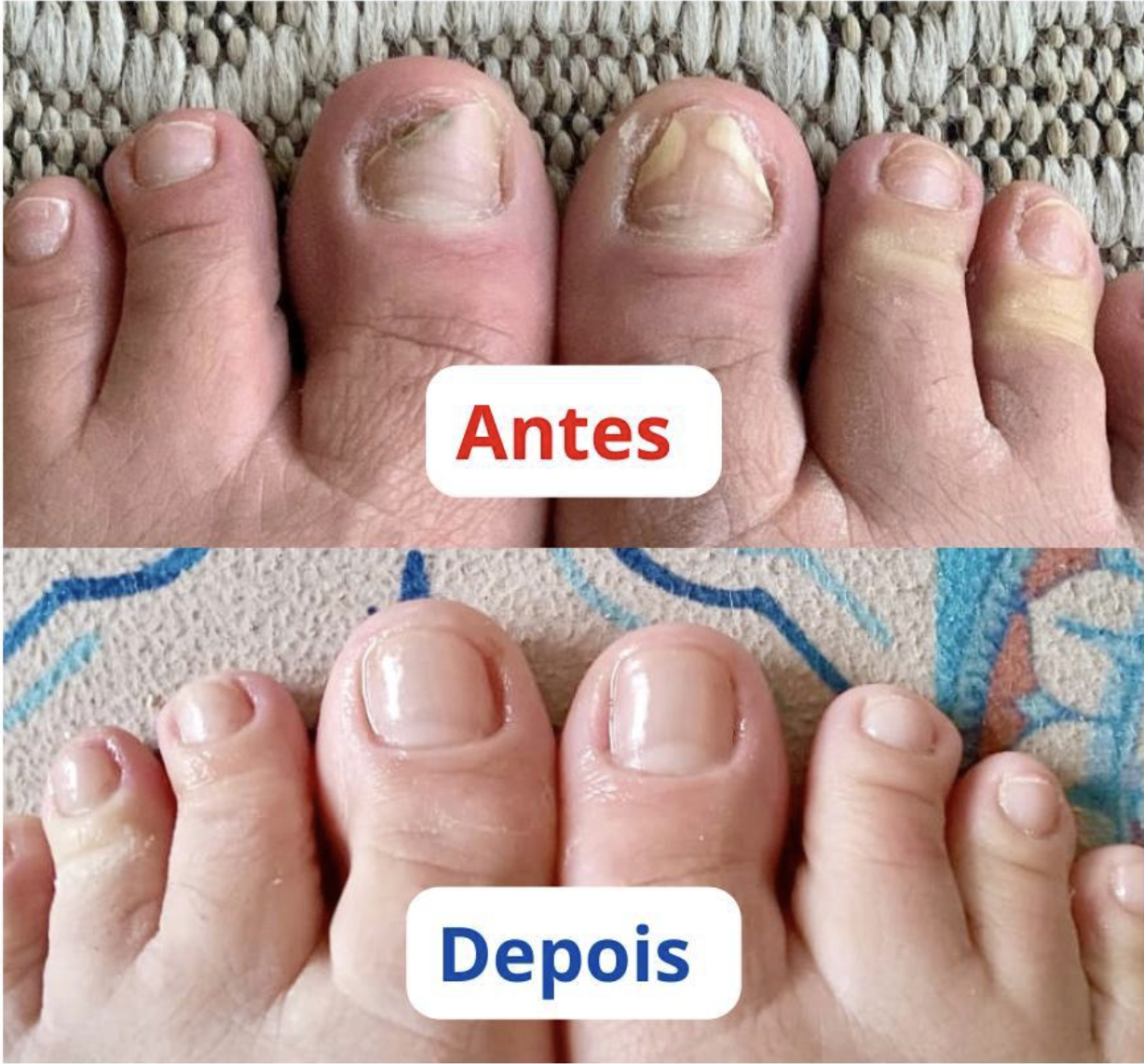 Antes e depois do tratamento com Blend Fungicida