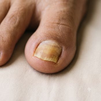 Unhas Amareladas